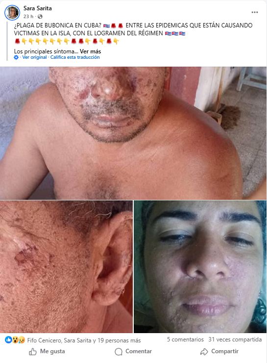 Fiebre bubónica en Cuba