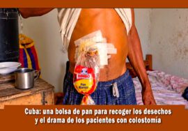 En Cuba paciente con colostomía usa bolsa de pan