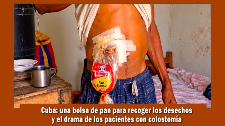 En Cuba paciente con colostomía usa bolsa de pan